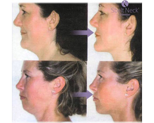 Масажер для щік InnovaGoods для зменшення подвійного підборіддя